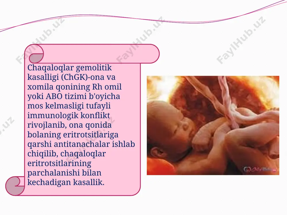 kmol'/l 3 zona – eb 200 mkmol'/l 4 zona - eb 250 mkmol'/l 5 zona - eb 250 mkmol'/l dаn ko'p anemik shakli anemik shakli hayotining 1-3 xaftasida namoyon bo'ladi. anemik shakli nevrologik status o'zgarmagan; anemik shakli yengil kechishi, asorat kuzatilmaydi jigar va taloq bir’oz ka’ttalashadi anemiya retikulocitoz bilan teri o'qarishi, yengil ikteriklik; yengil darajasi нв miqdori- 150 g/l kindik qonida eb 60 mkmol/l gacha koncervativ davo qilinadi bilirubinni soat sayin ortishi 5 mkmol/l dan kam yengil sariqlik kuzatiladi o'rta ogi'r darajasi hb miqdori 100-150 mg/l dan kam kindik qo’nida eb 85 mkmol/l gacha ko’tariladi; encefalopatiya rivojlanish xavfi bo'ladi bilirubin soat sayin o’sishi 5 mkmol/l dan ko'p sariqlik 5-10 soatdan so’ng paydo bo'ladi; оgi'r darajasi hb miqdori 100 g/l dan kam кindik qonida eb 85 mkmol/l dan ortiq; qon almashtirib quyishga ko’rsatma mavjud bo'ladi encefalopatiya belgilari kuzatiladi sariqlik tug’ilgandanoq bo'ladi bilirubinli encefalopatiyaning fazalari 1-faza bilirubinli intoksikatsiya belgilarini paydo bo'lishi (bo’shashish, …