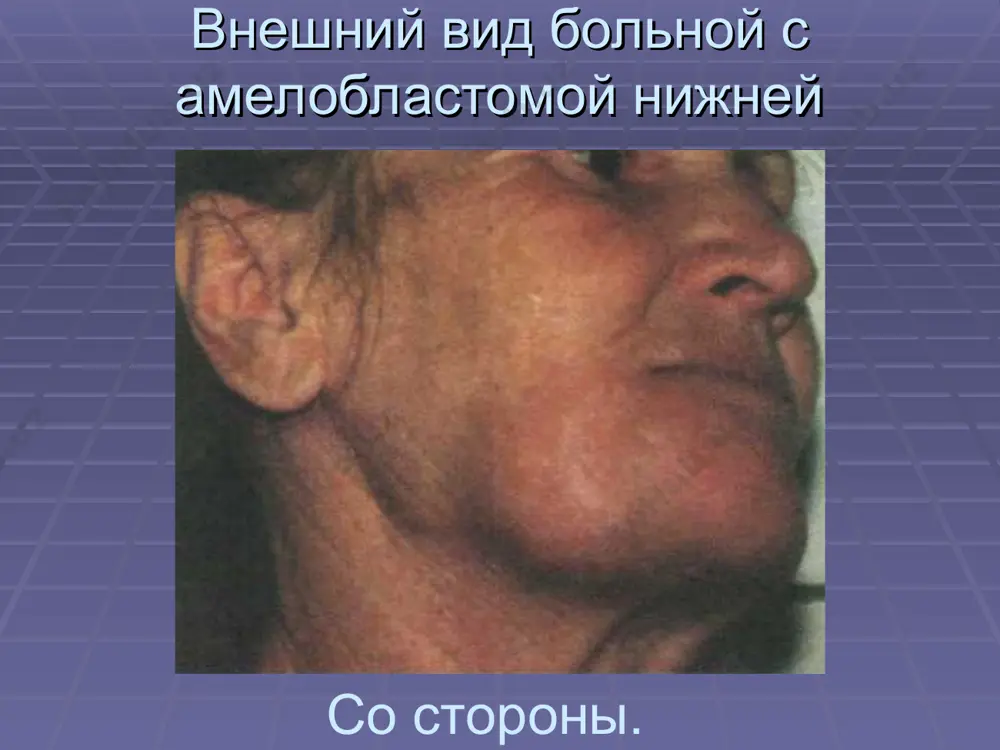 амелобластома - Page 5