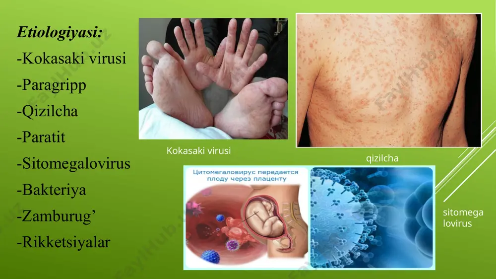 rrent kasalliksiz va yoki onaning homiladorlik davrida anamnestic malumotlar bo’yicha aniqlansa ehtimolli deb qaraladi. erta karditning morfologik belgisi endo va miokardning fibroelastoz yoki elastofibrozidir. makroskopik erta tug’ma karditlarda dilyatatsiya va chap qorincha miokard gipertrofiyasi bilan kechuvchi kardiomegaliya aniqlanadi, uning endikardi ancha qalinlashgan bo’ladi. deyarli 2/3 bemorlarda klapan apparati shikastlanishi kuzatiladi. erta tug’ma karditning klinikasi: ekstrakardial:- tana vazning sababsiz kam qo’shilishi, jismoniy rivojlanishdan orqada qolish, rangparlik, lanjlik, ko’p terlash afoniya, sababsiz bezovtalanish xurujlari. kardial: shilliq qavatlarning, barmoq uchlarining yengil sianozi chap tomonlama yurak bukriligi yurak turtkisi susaygan yoki aniqlanmaydi tonlarining bo’g’iqlashuvi , taxikardiya labarator: echt, leykotsitlar, qon zardobi oqsil fraksiyalari normada yoki ozgina o’zgargan bo’ladi. rentgenda: chap o’pka pastki bo’lagi atelektazi - yurakning sharsimon yoki oval ko’rinishi -chap qorinchaning kuchli dilyatatsiyasi bn birga yurak bo’shliqlarining kattalashishi ekgda: -tug’ma fibroelastozda qrs komplekslarining yuqori voltaji -ishemiya belgilari bn subendocardial bo’limlarining ishemiyasi ( st segmentining izochiziqdan pastga siljishi va manfiy t tishcha) kechki tug’ma …