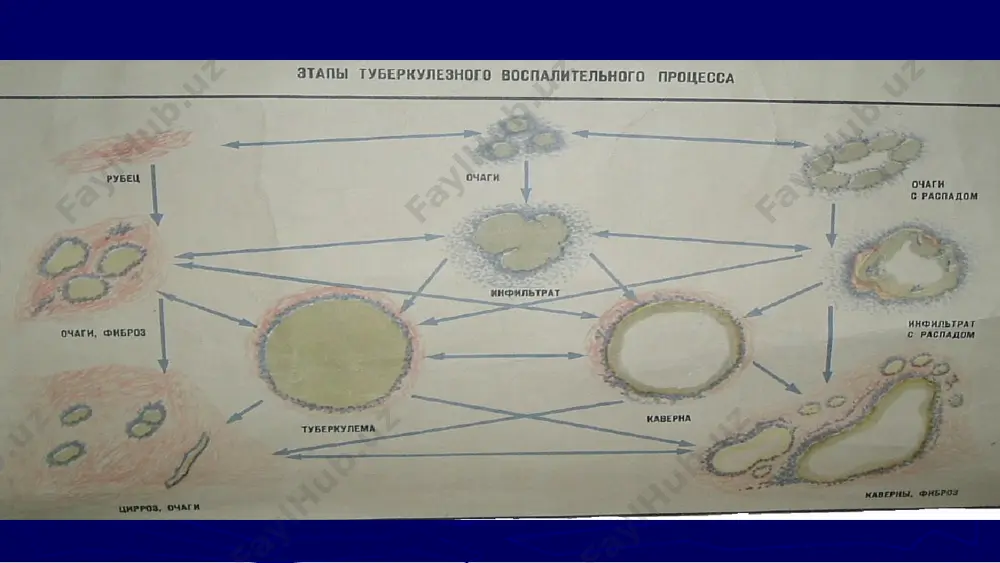 o'pkaning kavernali, fibroz-kavernali va tsirrotik tuberkulezi - Page 4