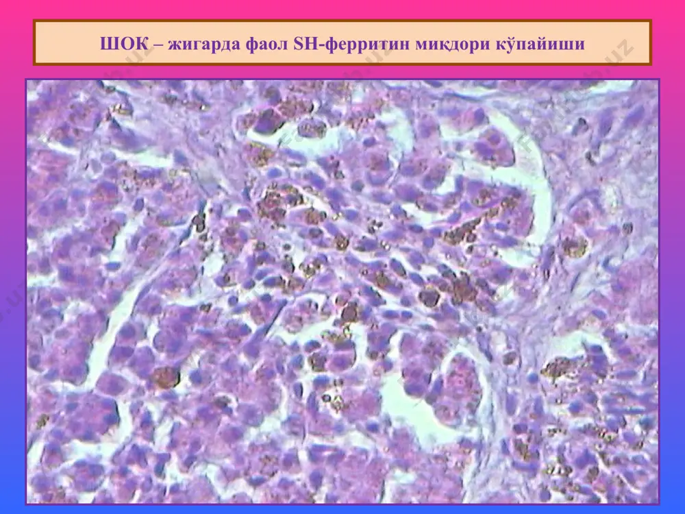 jaundice are various, that allows to allocate three its principal views: 1) supperhepatic (hemolitic), 2) hepatic (parenchimatous), 3) upperhepatic (mechanical). 1.гемолитик сариқлик – мандарин ранги. 2.паренхиматоз сариқлик – лимон ранги. 3.механик сариқлик – аппелсин ранги. аралаш дистрофиялар патологик гемоглобиноген пигментлар 1. гематоидин. 2. гематин (безгак гематини, нсiли гематин, формалинли гематин). 3. порфирин. гематоидиннинг пайдо бўлиши ва жойланиши пайдо бўлиши: 1.ҳужайра ичида пайдо бўлади. 2.ҳужайра ташқарисида, некроз таркибида тўпланади. жойланиш жойи: 1.гематомаларда. 2. чандиқланаётган инфаркт ўчоғида. аралаш дистрофиялар in a hematoma the pigment hematoidin is formed also. if to investigate a hematoma prescription more than 7-10 days on periphery and in live cages it is possible to find out a brown pigment hemosiderin, and in the centre of dead fabrics - crystals hematoidin. безгак гематини пайдо бўлиш механизми 1.безгак плазмодийсининг эритроцитга кириши. 2.гемоглобиндан глобиннинг ажралиши. 3.гемнинг оксидланиши. 4.плазмодийнинг ичида қора рангли пигментнинг пайдо бўлиши. аралаш дистрофиялар хлорид кислотали гематиннинг пайдо бўлиш …
