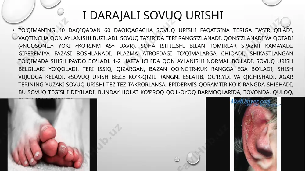 h darajasin aniqlash mumkin bo'ladi. uning belgilari sovuq urishning kuchliligi davomliligiga bog'liq bo'ladi. tezkor kontakt sovuq urishlar qattic muzrlagan metallar, ashyolar, karbonat angidrid (-110°c) yoki erigan have (-140°c) ta’sirida ro'yobga chiqadi. ko'pincha kontakt sovuq urish burun qo'l-oyoq, yuz, lab, til va quloqda kuzatilib, odatda iii va iv darajal bo'ladi. birinchi yordam va davolash reaktiv davrda davolash tomirlai spazm ini yo'qotishga qaratilgan bo'lib, bunda kislorodga bo'lgar ehtiyojni qondirish zarur. buning uchun vazokonstriktor holatni yo'qotisl kerak, tomir ichiga kishi haroratidan yuqoriroq isitilgan suyuqliklai yuboriladi va bemor isitiladi. sovuq urgan joyni qor bilan ishqalasl infeksiya tushirish imkoni bo'lgani uchun zararlidir. mahalliy soha spirt gibitan suyuqligi yoki teri rangiga ta ’sir qilmaydigan antiseptik moddala bilan dizenfeksiya qilinadi va isituvchi steril doka, paxta bog'lab qo'yiladi. sovuq urgan sohani tez isitish mahalliy nekrozga olib kelishi mumkin, ayniqsa issiq suvli vannaga tushirish mumkin emas. reaktiv davrda davolash sovuq urishining darajasiga bog'liq. birinchi darajali sovuq urishda quruq bog'lam …
