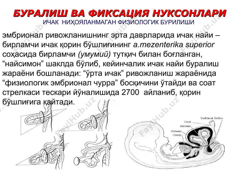 joylashib, paraumblikal va epigastral churralarga bo'linadi qorin old devori churralari ichidagi salmog'i 1% ni tashkil qilib, ko'pincha 2-3 yoshdan keyin aniqlanadi. churra qisilishi juda kam hollarda uchraydi. siydik kopi ekstrofiyasi klinikasi. qovuq usti sohasida u yoki bu kattalikda bo'lgan o'smasimon hosilani ko'rish mumkin. bu hosilaning rangi qip-qizil bo'lib, u qovuq orqa devorining bo'rtib chiqishidan hosil bo'ladi. ozgina shikastlanishda ham uning shilliq qavatidan kapillyar qon ketishi kuzatiladi. hosilaning pastki qismida ikkita kichkina teshik bo'lib, u odatda siydik nayining teshiklaridir. bu teshiklardan har doim siydik ajralib turadi. . vaqt o'tgan sayin hosila devorida qo'shimcha to'qima o'saverib, uning elastikligi tobora yo'qolaveradi. shilliq qavat yuzasida papillomatoz shish aniqlanadi. bemorlar kuchanganda, yig'laganda qovuq devori yana ham ko'proq bo'rtib chiqadi, bu holda siydik naylari teshigidan siydik chiqarish ham kuchayadi. hosila atrof terisi chaqalanadi. ko'pincha, ekstrofiya bilan bir qatorda tug'ma chov churrasi, kriptorxizm, siydik chiqarish sistemasida har xil nuqsonlar, qov simfizi bitmasligi, tug'ma son chiqishi kuzatiladi. totalnaya …