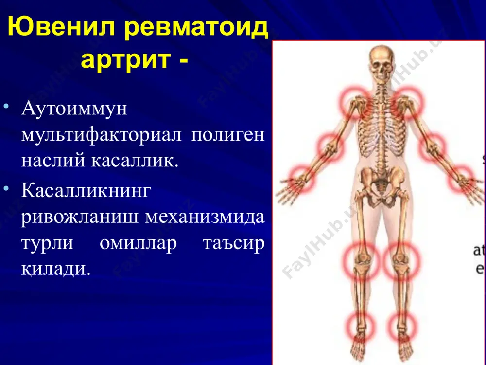 инг 2 та асосий варианти бор: стилл синдроми висслер-фанкони синдроми бўғим-висцерал шакли асосий клиник симптомлар стилл синдроми висслер-фанкони синдроми ўткир бошланиши + + ўртача иситма + - юқори давомли иситма - + майда бўғимлар зарарланувчи полиартрит + - йирик бўғимлар зарарланувчи полиартрит - + давомли артралгия - + лимфоаденопатия + + гепатоспленомегалия + + полисерозит + + миокардит + + камқонлик + - нейтрофил гиперлейкоцитоз - + эчт яққол ортиши + + ревматоид артрит ташхиси юранинг ўзига хос хусусиятлари қуйидагилар: касалликни 16 ёшгача ривожланиши; артрит клиникаси (бўғимлар шиши, суюкликни борлиғи, бўғим соҳасида ҳарорат кўтарилиб, ҳаракат ҳажмининг чегараланганлиги ва оғриқ); касаллик 6 ой ва ундан кўп давом этиши; юранинг асосий шакллари (бўғим-висцерал, олигоартикуляр, полиартикуляр) қуйидагилар билан ташҳисланади: а) иситма бор ёки йўқлиги; б) касалликнинг биринчи 6 ойида шикастланган бўғимлар сони . лимфоаденопатия увеличение лимфоузлов всех групп наиболее выражена при системных формах заболеваний (увеличение до 4 – 6 см в диаметре) и …