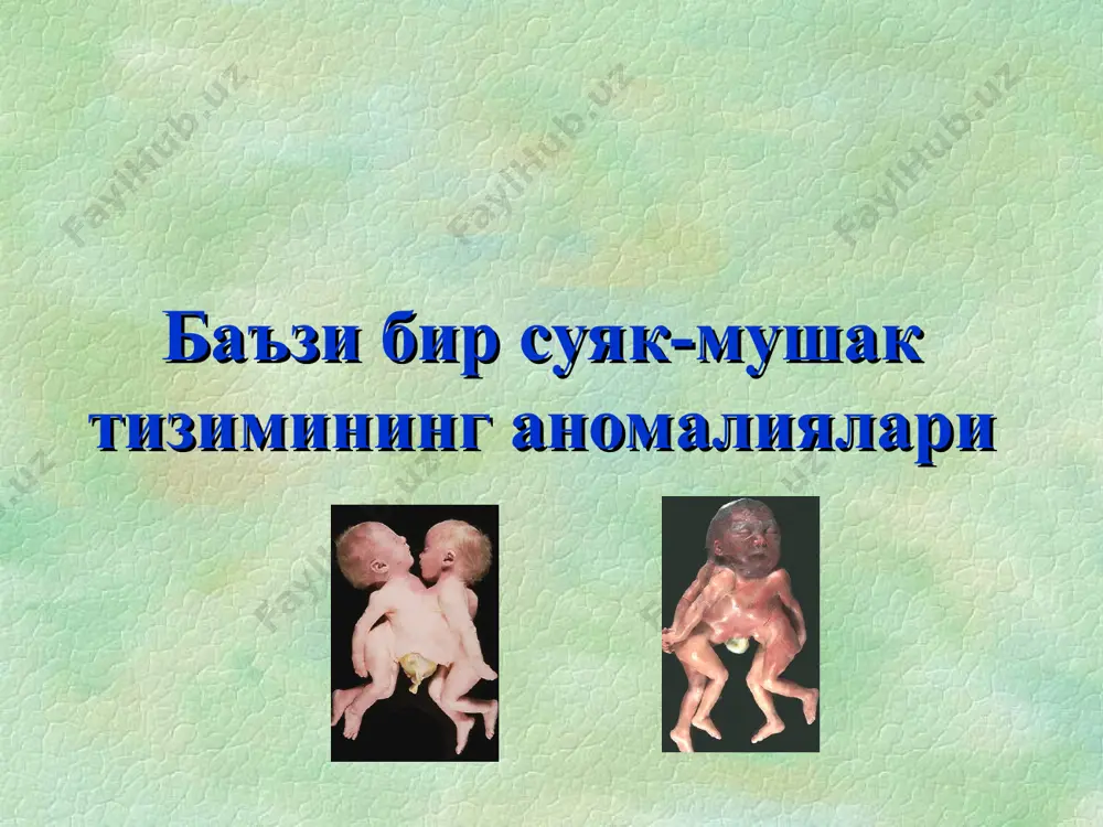 гача ( 1 см гача). б –омбредана линияси l – ацетабуляр бурчак (индекс) . нормада 30 дан юқори ( ятч ларда) путти схемаси хильгенрейнера схемаси рентгенография ва компьютерно-томографик тахлиллар компютер томограммасида сон суяги бўйинчаси чин антивервиясини аниқлаш сон суяги туғма чиқишида чаноқ-сон бўғимини контраст текшириш стандарт артрография мрт сон суяги туғма чиқиши клиникаси симптом ортолани-маркса – шиқиллаш симптом барлоу- соннинг орқага силжиши симптом галеацци – соннинг қисқариши сон абдукциясининг чегараланиш симптоми тери бурмалари асимметрияси оёқларнинг ташқи ротацияси сон суяги бошчасининг ортиқча ҳаракатчанлиги ортолани-маркс симптоми бола ҳаётининг илк ҳафталаридан намоён бўлади симптом барлоу симптом галеацци сон абдукциясининг чегараланиш симптоми тери бурмалари асимметрияси туғма сон чиқишининг кечки белгилари нормал ривожланаётган бола 8-12 ойликда юра бошлайди. ифодаланган сон суяги дисплазияси/чиқишида бола 2 ёшида юра бошлайди. туғма сон чиқишининг кечки белгилари тренделенбург симптоми. чўлоқланиш ёки «ўрдаксимон юриш» туғма сон чиқишининг утт белгилари 6 ойгача оптимал туғма сон чиқишининг рентгенодиагностикаси хильгенрайнер схема туғма сон чиқишининг …