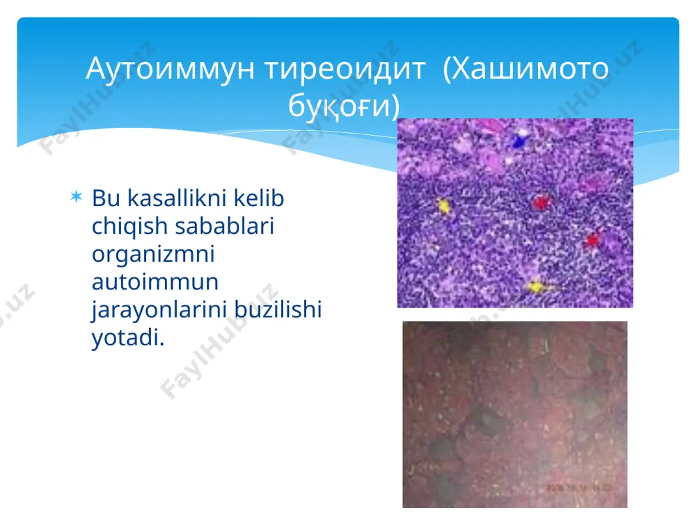 rni ko’payganini ko’ramiz animiya xam bo’lishi mumkin.protoenogrammada teroglabulinni ko’payib ketganini ko’rishimiz mumkin.kasallikni boshlang’ich davrida qalqonsimon bezni j131 ni qabul qilishi ortgan. kasallik avj olib borishi bilan qalqonsimon bezni yo’dni qabul qilishi kamayib ketadi.tekshiruvda qalqonsimon bezning qismlari izatopni ko’p yutganligi aniqlandi, limfa tugunlari infiltratsiyaga uchragan qismlar esa izatopni kam yutgan. qalqonsimon bezni aspiratsion biopsiya qilinganda limfasitlarni yig’ilib qolganini, prolimfositlarni, plazmatik xujayralarni,deginiratsiyalangan folyukulyar xujayralarni va askanazi xujayralarini ko’rishimiz mumkin. autoantitelalar,tireoglabulinlar, кkolloid moddalar, mikrosamal fraksiyalar ko’p miqdorda aniqlanadi. diagnostika qilish maqsadida oz miqdorda prednezalon berib ko’riladi. prednezalonni 15 mg dan 7-10 kun bemorga beriladi. . autoimmun terioditda qalqonsimon bezni qattiqligi buziladi. текшириш усуллари quydagi kasalliklar bilan diferesatsiyalanadi: eutereoil buqoq, qalqonsimon bez raki, diffuz toksik buqoq bilan qiyoslanadi. tugunli eutereoil buqoq. umumiy belgilar: qalqonsimon berzning kattalashishi, yuzasida tugunlarni , поaydo bo’lishi, bezning og’riqsiz bo’lishi va uning xarakatchan bo’lishi. eutereoil buqoqda , prednezalon bilan davolanganda davoga berilmaydi. qalqonsimon bezning rakida autoimmun jarayonlar bo’ladi va bunga …