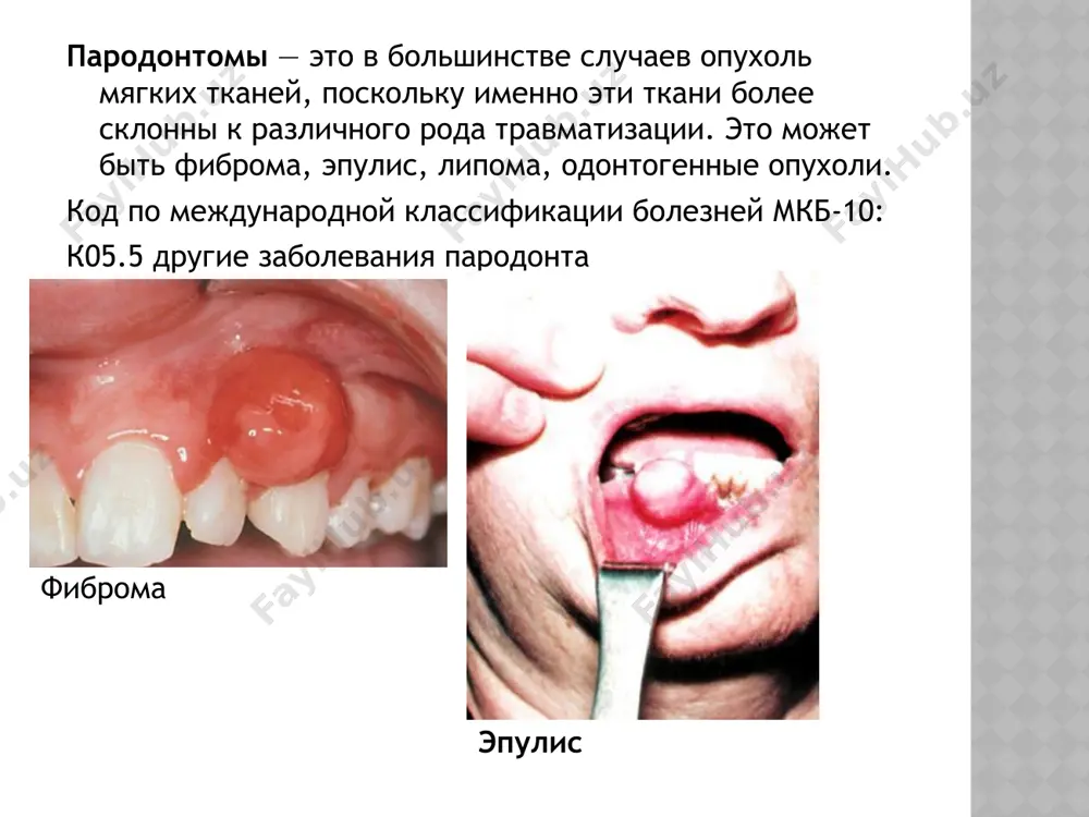 ы полости рта — слизистая языка и щек. на языке и слизистой дна полости рта иногда встречаются новообразования смешанного типа — фиброгемангиома, фибролипома и т. п. фиброма от раздражения не является истинной опухолью, а представляет собой результат гиперплазии реактивного характера, развивающейся в ответ на хроническое раздражающее воздействие механических или химических факторов. это наиболее часто встречаемый тип фибромы полости рта. фиброма от раздражения появляется на слизистой в виде папулы розоватого цвета. по мере роста она трансформируется в имеющий правильную округлую форму плотный узелок. повторное травмирование может привести к появлению бугристости на поверхности образования и его изъязвлению. симметричные фибромы образуются в области третьих маляров на небной поверхности десны. они имеют плотную консистенцию и бобовидную форму. эти образования не являются истинной фибромой полости рта, а представляют собой разрастание десны, сопровождающееся рубцовыми изменениями. дольчатая фиброма полости рта отличается бугристой поверхностью и возникает в результате реактивной гиперплазии тканей десны при ее хроническом травмировании съемным протезом. …