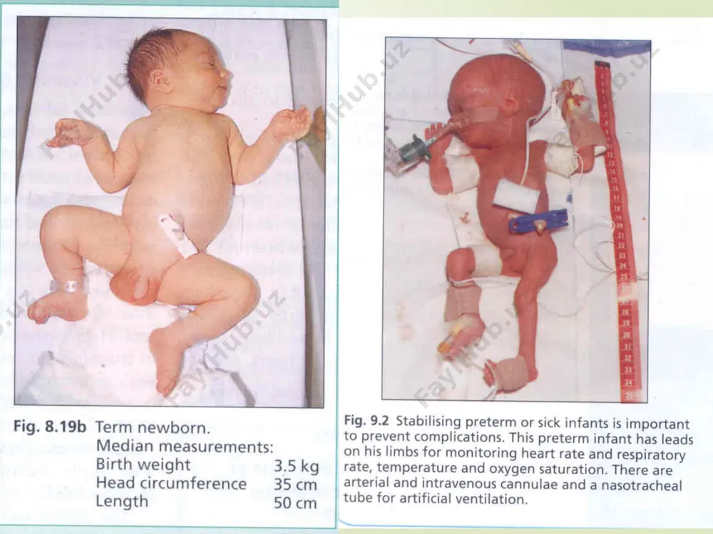 ti yosh bo`yicha 35 s 34 s 33 s 32 s 1,5kg dan kam hayotining 10 - 12 kunlari hayotining 11- kuni - 3 haftasi hayotining 3-kuni – 5-haftasi 5 haftadan kattaroq 1,5 - 2,0kg hayotining 1 -10 kunlari hayotining 3-kuni - 5 haftasi 4 haftadan kattaroq 2,1 - 2,5kg hayotining 1 - 10 kunlari hayotining 11- kuni - 3 haftasi 3 haftadan kattaroq 2,5kg dan ortiq hayotning 1-2 kuni hayotning 2- kunidan kattaroq inkubatorda tavsiya qilinadigan harorat muddatiga etmay tug’ilgan bolalarni ovqatlantirish ovqatlantirish bo`yicha masalalarni hal qilish uchun to`rtta asosiy savolga javob berish shart: qachon boshlash? qanday hajmda? nima afzalroq? ovqatlantirishni qanday usulda olib borish? muddatiga etmay tug’ilgan chaqaloq uchun o`z onasining suti eng afzal oziqadir. ba`zi bir xolatlarda maxsus moslashgan sut aralashmalari va parenteral ovqatlantirishdan foydalaniladi. muddatiga etmay tug’ilgan chaqaloq usib-ulg’ayishi uchun kup miqdordagi kalloriyaga muxtoj – 120-140 kkall/kg/kuniga. muddatiga etmay tug’ilgan me`dasining xajmi ± 20 ml/kg. ularni …