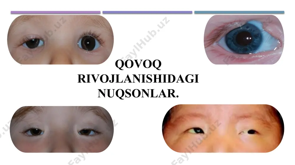 ushgan. ko’z yorig’ining yopilishi keskin cheklangan bo’ladi. yuqori qovoq ko’z olmasini bosib turishi natijasida, kon’yunktiva va episkleraning tomirlarida qon aylanishi buziladi, bu o’z navbatida shox pardaning oziqlanishini yomonlashishiga olib keladi. davolash: erta davrda jarrohlik davo tavsiya etiladi. davolash taktikasi, keyinchali ptozni bartaraf etuvchi kontoplatstikani o’z ichiga olgan, qovoqlarni ko’p bosqichli rekonstruktiv jarroxlik amaliyotidan iborat bo’ladi. ankiloblefaron (ankiloblefaroni) - qovoqlarining tug’ma qisman yoki to’liq o’sib qo’shilib ketishi. juda kam uchraydigan kasallik. klinikasi: qovoqlarning o’sib qo’shilib ketishi, ko’pincha, chakka tomondan, ba’zan – burun tomondan kuzatiladi. bunday holatlarda, ko’z yoshi a’zolari burun tomonga siljiydi, pastki ko’z yoshi kanalchasining uzunligi ham ortadi, ko’z yoshi do’mboqchasi qovoqning ichki qismiga o’sib kiradi. diagnostika: tashxis anamnez ma’lumotlarini to’plash va ko’zning tashqi tekshiruvi natijalariga ko’ra qo’yiladi. oftalmologik tekshiruvlar ham o’tkaziladi. davolash: ushbu patologiyani davolash faqat jarrohlik usulida amalga oshiriladi. mikroblefaron (mikroblefaroni) - vertikal meridianda qovoqlarning sezilarli qisqarishi, ular to’liq yopilmaydi va natijada lagoftalm kelib chiqadi. klinikasi: ko’z yoshlanadi, …