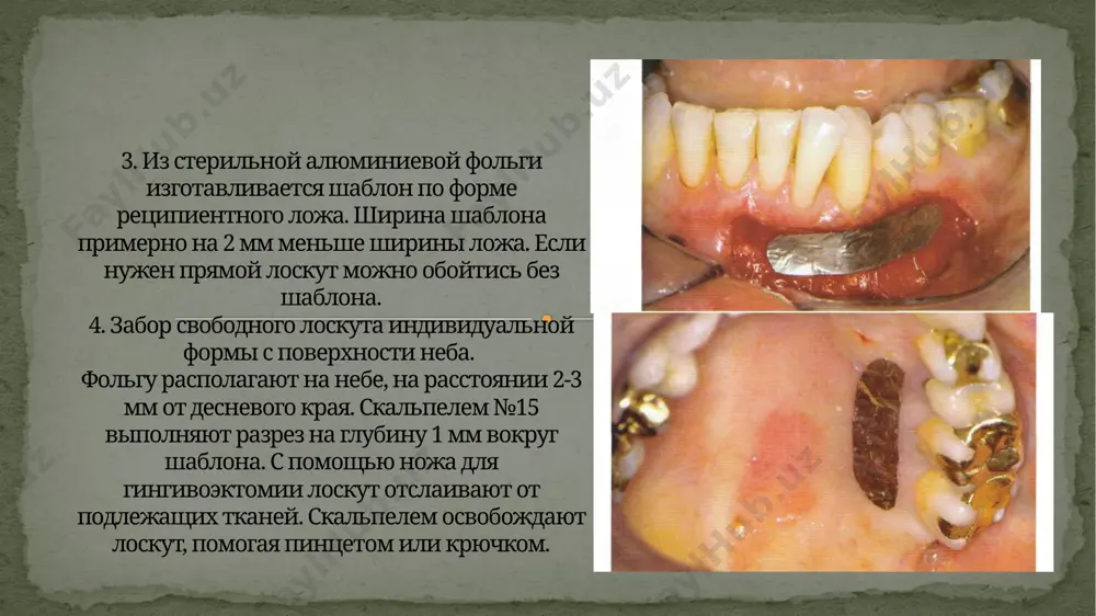 еподвижность раневой поверхности на ближайшие несколько дней. 6. фиксация сдл лоскут фиксируют, используя атравматичный шовный материал и острую изогнутую иглу, а затем на несколько минут прижимают влажным марлевым тампоном. механическая чистка зубов в зоне операции отменяется на 14 дней. назначают полоскания раствором хлоргексидина. сдл приживается без осложнений , если при толщине 1 мм он содержит не только эпителий, но и собственную пластинку слизистой оболочки (0,5 мм). примерно через 2 дня после операции часть эпителия отшелушивается. при этом лоскут на первый взгляд кажется некротизированным. дело в том, что успех приживления зависит не от эпителия, а от соединительнотканного слоя. новая эпителизация начинается с десневого края реципиентного ложа. даже те клетки, которые нарастают на лоскут с подвижной слизистой оболочки, дифференцируются затем в ороговевающий «небный» эпителий. через 1 нед. лоскут полностью приживается к поверхности ложа и покрывается новым эптелием. полное ороговение занимает примерно 4 нед. благоприятный исход спустя 6 нед. после операции: произошло полное …