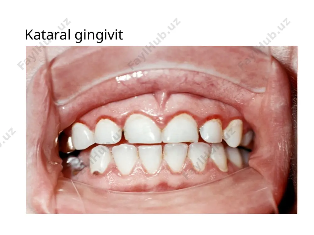 paradont kasalliklari nur tashxisi - Page 3