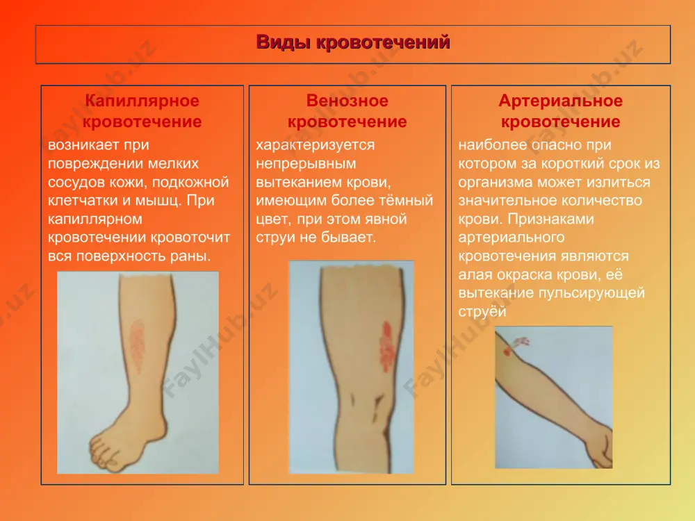 кровотечение в травматологии - Page 5