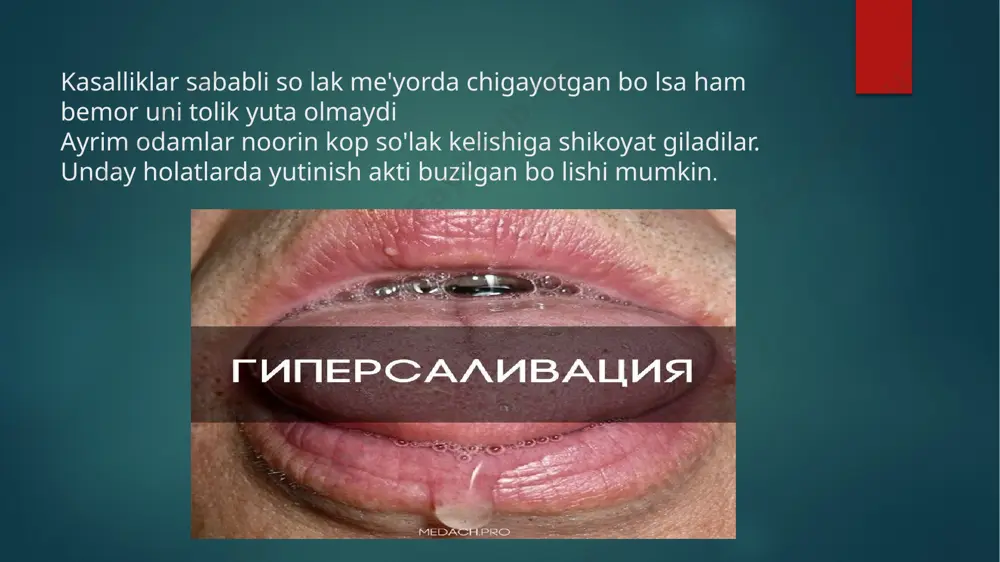qattiq va usti gadir-budur bo'ladi ammo og'riq bo'lmaydi. organizmdagi asosiy kasallikning xuruji va reaktivligi susaishi va boshqa sabablar bilan kasallik xuruj berishi mumkin rentgenologik tekshiruv va qiyosiy tashxis rentgenologik tekshiruvlar. sialogrammada bez parenximasi yaxshi ajralib ko`rinmaydi. asosan, kontrast moda bilan har xil shakildagi chegarasi aniq bo'lmagan bo'shliqlar aniqlanadi. so'lak chiqaruv yo'llarikengayib tekisligini yo'qotadi. mayda so'lak yo'llari uzilib ko`rinadi. ultratovush tekshiruvida so'lak bezlarining kattalashgani, parenximazichligi o`zgarganligi hisobiga gipoexogen va giperexogen strukturaga egaligi kuzatiladi.so lak sitologiyasida deskvamatsiyaga uchragan epitelial hujayralarning ko'pligi, hujayralarda shish va parchalanish kuzatilishi, yog` hujayralari distrofiyasi va yog' metabolitlari uchraydi. qiyosiy tashhislash. shegren kasalligidagi sialodenitni parenximatoz va interstitsial nospetsifik surunkali parotitlaridan, surunkali sialodoxit va so`lak bezi o'smalaridan farqlash kerak mikulich kasalligi [sindromi] mikulich kasalligi (sindromi)ko'z yosh bezlari va hamma so`lak bezlarining birgalikda kattalashishini mikulich birinchi bo'lib yozgan va muallif nomi bilan yuritiladi. kasallik yuqorida keltirilgan shegren kasalligiga juda o'xshab ketadi. farqi mikulich kasalligida bezlar sekretsiyasi buzilmaydi. agarda so'lak va …