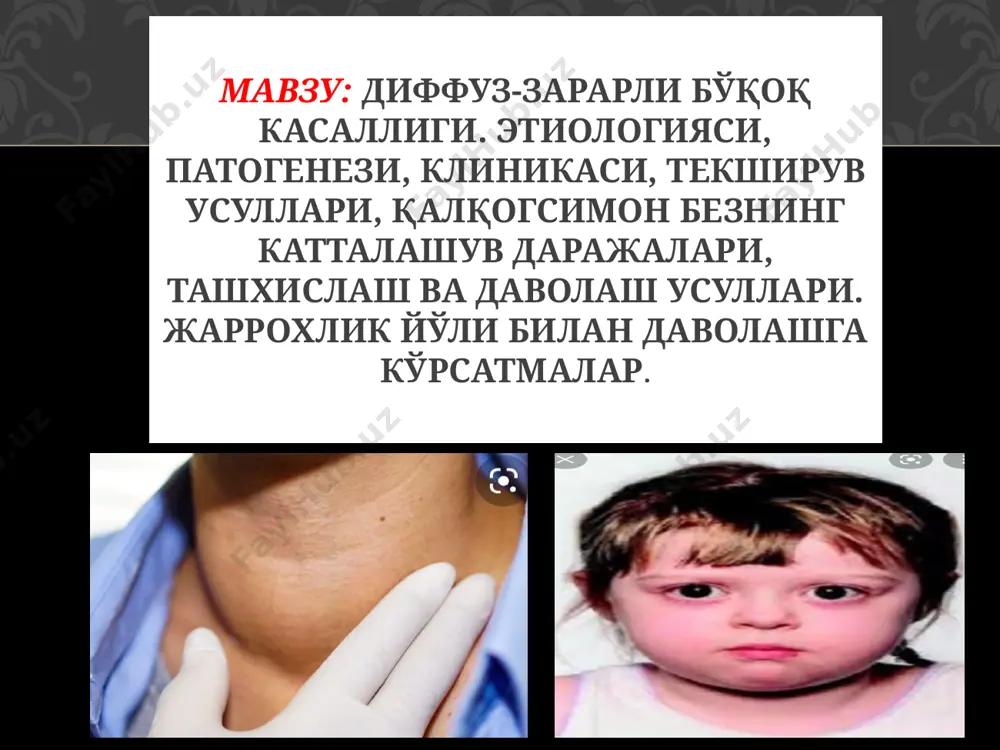 ми тамонидан зарарланишлар, ортикча миқдорда йод препаратини қабул қилиш, организмнинг ортиқча исиб кетиши касалликнинг келиб чиқишида асосий туртки бўлиб ҳисобланади. болаларда кўпроқ касаллик ўткир инфекциялар: грипп, ангина, кизамик, кўкйўтал, ревматизм касалликларидан кейин келиб чиқади. шеришевский фикрича- тамоқ соҳасида зарарланиш билан кечадиган инфекциялар сабаб бўлади этиологияси: касалликнинг патогенези тўлиғича урганилмаган. охирги 20-30 йиллар давомида дтб касалликнинг аутоиммун механизм жараёнлар билан келиб чиқиши эксперементаль ва клиник далиллари асосида исботланган. нlа антегенларни ўрганиш шуни кустатдики, дтб касаллигида кўпроқ нlа – 8 антеген билан ирсиятга ўтар экан ва соғ одамларга нисбатан 2, 5-3 марта кўп қайд қилинар экан. касаллик патогенезида тўқималар дейодизацияси ҳам муҳим аҳамият касб этади. дейодоза ферменти активлигининг ошиши тереоид гормонларнинг тўқималарга таъсирини кучайтиради. патогенези. қалқонсимон безнинг катталашиш даражаси бўйича бир қанча классификация мавжуд. ҳозир бизнинг мамлакатда о. в. николаев тақдим қилган қуйидаги классификация амалиётда кўпроқ қўлланилади. 1-даражаси –қалқонсимон безнинг бўйин қисми пайпаслаганда бироз катталашган. 2-даражаси –қўлга без ангил пайпасланади, ютунганда эса …