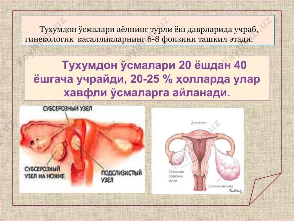 yuqlik to'planishi tufayli ro'y beradi bunday o'smasimon kattalashgan bo'shliqlar yallig'lanishi, hayz tsiklini buzishi, tuxumdon endometriozlari(10%) va boshqa kasalliklar rivojlanishiga olib kelishi mumkin. follikulyar kista (75%), sariq tana kistasi (5%), tuboovarial, paraovarial (10%), gartner yo'li, qin kistasi va endometrioz kistalari (tuxumdonda) uchraydi follikulyar kistalar ko'pincha mioma bo'lganda, klomifen dori qo'llagandan keyin, lyutein kistalar esa elbo'g'oz va xorion epiteliomada uchraydi. 34% hollarda uchraydi follikullar erimay, sariq tana orqaga qaytmaydi, yani shu jarayon to'xtab qolishi tufayli hayz tsiklining izdan chiqishi kuzatiladi bu kistalar shakli jihatidan yumaloq, aylanasi 6-8 sm retentsion kistalar odatda konservativ usulda davolanadi klinik belgilarsiz kechadi kistalar oyoqchalar buralishi tufayli o'tkir qorin belgilari kuzatiladi blastomatoz kistomalar chin o'smalar - o'smalar o'sishi to'qimalar proliferatsiyasi, - 66% ni tashkil qiladi. - bo'shliqlarning suyuqlik bilan to'lishi tufayli kuzatiladi. tuxumdon o'smalarining turli-tuman to'qimalardan o'sishi bo'yicha - epitelial biriktiruvchi to'qimadan tuzilgan, teratoid gormonal o'smalarga bo'linadi. chin o'smalar: xavfsiz xavfli xavfli o'smalar hujayralarning atipik bo'lishi, to'qimasining kam …
