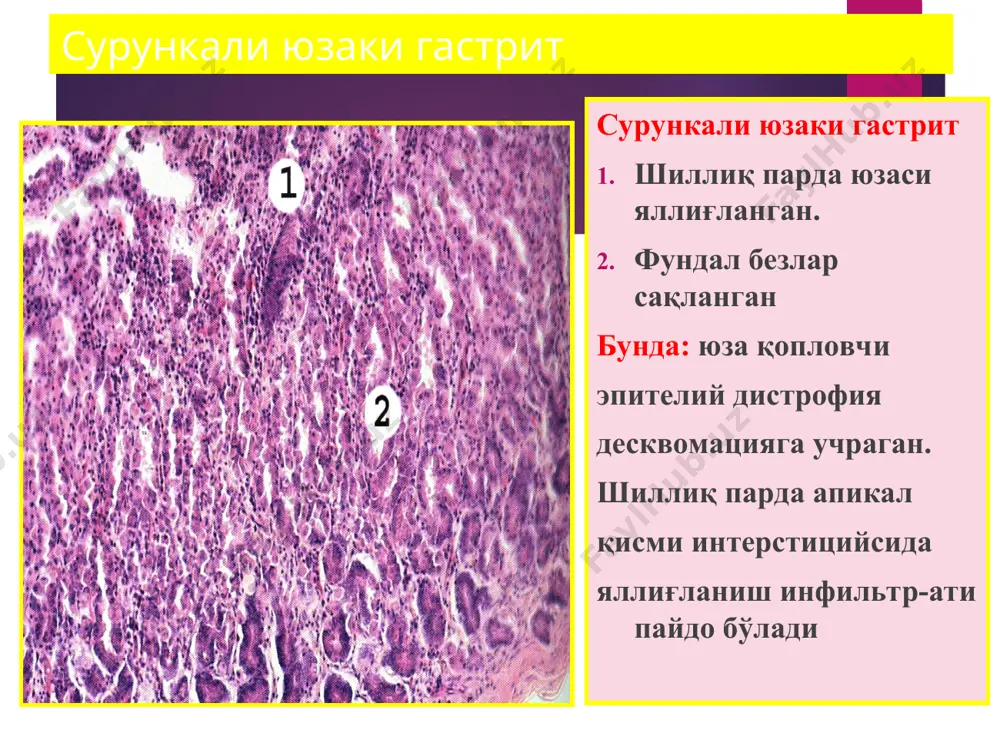 патологик анатомия “меъда-ичак касалликлари” - Page 5