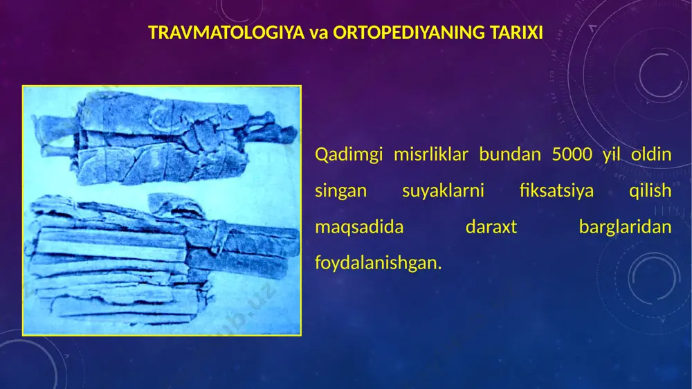 maslahat beradi. 7 travmatologiya va ortopediyaning tarixi hozirgi kundagi zamonaviy teri plastikasini otasi italiyalik olim gaspar tagliacozzi (1546-1599), boloniya universiteti professori. u tomondan ishlab chiqilgan usul (burun plastikasi) hozirgi kunda italiyancha usul deb yuritiladi, va hozirgi kunda ishlatiladigan teri plastikasini ko’p usulini asosi bo’lib hizmat qiladi. 8 travmatologiya va ortopediyaning tarixi g. dupuytren (1777-1835) kichik boldir suyagini sinishi (1819), tug’ma son chiqishi (1820) va qo’l barmoqlari kontrakturasi haqida juda katta ma’lumotlar berdi (1832). 9 travmatologiya va ortopediyaning tarixi deformasiya haqida fan 1741 yilga kelib parij universiteti professori nikolas andri tomonidan yagona mustaqil fan sifatida ommaga taklif qildi va «ortopediya» deb nomladi. 10 travmatologiya va ortopediyaning tarixi u birinchi bo’lib ishemik kontraktura haqida ma’lumot berdi. 11 folkmann ishemik kontrakturasi 12 travmatologiya va ortopediyaning tarixi xix asr oxiri wilhelm conrad röntgen x-nurlarini buyuk ixtirosi bilan tarixga kirdi (28 dekabr, 1895y.). aynan shu vaqtdan boshlab aseptik davr boshlandi va jarroxlar uchun juda katta …