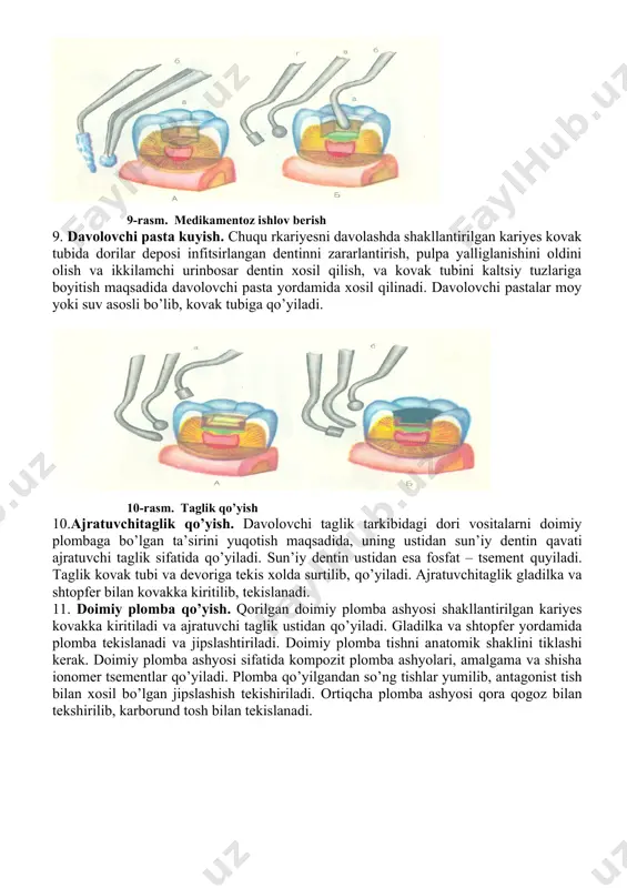 aydi. doriliishlovdan so’ng kariyes kovak iliqxavo oqimi bilan quritiladi. 9-rasm. medikamentoz ishlov berish 9. davolovchi pasta kuyish. chuqu rkariyesni davolashda shakllantirilgan kariyes kovak tubida dorilar deposi infitsirlangan dentinni zararlantirish, pulpa yalliglanishini oldini olish va ikkilamchi urinbosar dentin xosil qilish, va kovak tubini kaltsiy tuzlariga boyitish maqsadida davolovchi pasta yordamida xosil qilinadi. davolovchi pastalar moy yoki suv asosli bo’lib, kovak tubiga qo’yiladi. 10-rasm. taglik qo’yish 10.ajratuvchitaglik qo’yish. davolovchi taglik tarkibidagi dori vositalarni doimiy plombaga bo’lgan ta’sirini yuqotish maqsadida, uning ustidan sun’iy dentin qavati ajratuvchi taglik sifatida qo’yiladi. sun’iy dentin ustidan esa fosfat – tsement quyiladi. taglik kovak tubi va devoriga tekis xolda surtilib, qo’yiladi. ajratuvchitaglik gladilka va shtopfer bilan kovakka kiritilib, tekislanadi. 11. doimiy plomba qo’yish. qorilgan doimiy plomba ashyosi shakllantirilgan kariyes kovakka kiritiladi va ajratuvchi taglik ustidan qo’yiladi. gladilka va shtopfer yordamida plomba tekislanadi va jipslashtiriladi. doimiy plomba tishni anatomik shaklini tiklashi kerak. doimiy plomba ashyosi sifatida kompozit plomba ashyolari, …