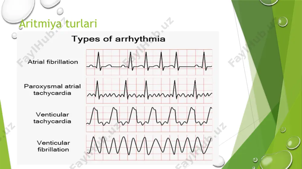 yurak aritmiyalari ekg diagnostikasi - Page 4