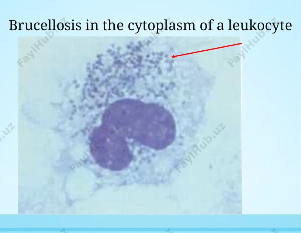 a long time inside macrophages, which may cause relapse and chronicity of the disease (mitka s/ et al. // j. clin microbiol 2007; 45: 1211–18) effectiveness of various combinations of antibiotics and duration of therapy for brucellosis according to data from various studies systematic review and meta-analysis solís garcía del pozo j, solera j (2012) systematic review and meta-analysis of randomized clinical trials in the treatment of human brucellosis. plos one 7(2): e32090. doi:10.1371/journal.pone.0032090 http://www.plosone.org/article/info:doi/10.1371/journal.pone.0032090 antibiotic therapy for severe forms of brucellosis (1) pappas g et al., nejm, 2005; 352: 2325–36 doxycycline 100 mg 2 times a day 6 weeks doxycycline with streptomycin, rifampicin, gentamicin, or ciprofloxacin; doxycycline and streptomycin in combination with rifampin or biseptol streptomycin 15 mg/kg im, 2–3 weeks streptomycin and doxycycline in combination with rifampin or biseptol antibiotic therapy for severe forms of brucellosis(2) pappas g et al., nejm, 2005; 352: 2325–36 rifampin 600–1200 mg/day for …