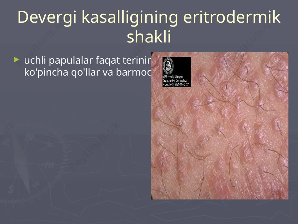 devergi kasalligining eritrodermik shakli - Page 5