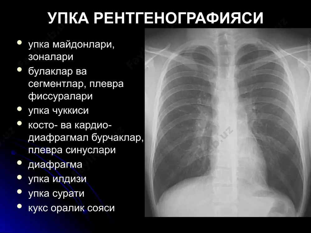 аклар 50-60 ешда купрок 3 сегмента сони купинча ягона улчами 4-6 см чегараси ноаник/ нотекис ногомоген (парчаланиш) «илдизга йул» + плеврит тез усади рак ичида кальцинат хеч качон булмайди !! гамартома эркаклар 50-60 ешда купрок упканинг перифериясида улчами 2.5 см гача чегараси аник кальцинатлар секин усади аденома ёшларда купрок марказда (бронх ичида) усмани узи купинча куринмади упкада - гипо/гипер/гипо вентиляция ва ателектаз, еки сурункали пневмония куринса – 2 см гача, юмалок, гомоген, аник текис чегара. бошка шарсимон патология шарсимон пневмония - клиникаси уткир!, чегаралари нотекис, тез динамика метастазлар - «упкадаги тангалар» симптоми, чегараси текис гомоген бир улчамдаги соялар упкадан ташкари патология - ярим шар/овал, линза шаклида, кенг асосда чикиб келган жойида «утиради» халкасимон корайиш касалликлар - хаволи киста, каверна, абсцесс, периферик рак, поликистоз, бронхоэктазлар девори калин бир текис эмас - периферик рак (+бошка белгилар) девори калин бир текис - абсцесс, каверна. атрофда инфильтрация. абсцессда - суюклик даражаси, каверна курук+ юкорида+учокли …
