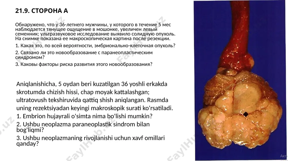 ik sindromlar bilan bog'liq emas. seminomlar sezilarli miqdorda androgen yoki estrogen gormonlarini ishlab chiqarishga moyil bo'lmasa-da, qondagi inson xorionik gonadotropin darajasining ko'tarilishi jinekomastiyaga olib kelishi mumkin. 3. moyak kasalliklari (masalan, kriptorxizm, androgenlarga befarqlik sindromi, klaynfelter sindromi) embrion hujayrali o'smalarning rivojlanish xavfini oshiradi. 21.9. сторона б 33-летнему мужчине, у которого в течение 1 года отмечается увеличение правого семенника, проведено ультразвуковое исследование, которое выявило солидное новообразование 4 см в диаметре. у него положительный результат теста на беременность (!). микроскопическая картина новообразования показана. 1. какая форма патологии, по вашему мнению, развилась у мужчины? 2. какой аномальный кариотип имеется у этого мужчины? 3. почему у пациента положительный результат теста на беременность? 4. какие виды терапии эффективны в подобной ситуации? 33 yoshli erkak 1 yil davomida o‘ng moyak kattalashgani bilan ultratovush tekshiruvidan o‘tkazildi, unda diametri 4 sm bo‘lgan qattiq neoplazma aniqlandi. u homiladorlik testining ijobiy natijasiga ega (!). neoplazmaning mikroskopik rasmi ko'rsatilgan. 1. sizningcha, erkakda …