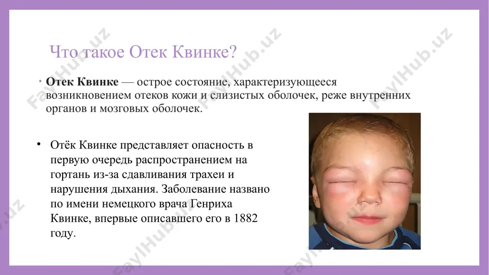 nizm razvitiya: ostraya allergicheskaya reaktsiya stanovitsya rezultatom trex mexanizmov: allergennogo, ne allergennogo, kombinirovannogo tipa: pri allergennom mexanizme vpervie vtorgaetsya allergen — eda, lekarstvo, piltsa, organizm vosprinimaet ego za antigen i narabativaet antitela. proisxodit povishennaya chuvstvitelnost k vozdeystviyu razdrajiteley. povtornoe vnedrenie allergena razrushaet kletku, soderjashuyu antitela. visvobojdaetsya gistamin i razvivaetsya otek. mexanizm razvitiya: pri ne allergennom mexanizme gistamin osvobojdaetsya v otvet na yad nasekomogo, lekarstva, pishevoy ili obonyatelniy razdrajitel. vrojdyonniy angionevroticheskiy otyok yavlyaetsya kombinirovannoy formoy. v krovi prisutstvuyut belki-komplementi v neaktivnom sostoyanii. aktivatorom mojet poslujit stressovaya situatsiya. belki sistemi komplementa prinimayut kletki xozyaina za antigeni. voznikaet otek. pervaya pomosh pri oteke kvinke: poskolku angionevroticheskiy otyok — eto dostatochno opasnoe sostoyanie, to vajno umet okazat pervuyu pomosh pri ego proyavleniyax. prejde vsego nujno vizvat skoruyu pomosh. nemedlenno prekratit kontakt bolnogo s allergenom, esli etot allergen izvesten. esli otyok nastupil posle vnutrimishechnogo vvedeniya preparata ili ukusa nasekomogo, to nujno nalojit davyashuyu povyazku vishe …