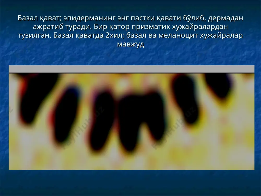 йирингча –ярим шарсимон шаклда, ўлчами 1-10 мм. эпидерма қаватидан тортиб гиподермагача тарқалиши мумкин. бирламчи пуфакчалардан ёки иккиламчи яллиғланган тугунчалардан хосил бўлиши мумкин чуқур жойлашган йирингчалар ўзидан кейин чандиқ қолдиради иккиламчи морфологик элементлар гиперпигментация- терида меланин синтезининг кўпайиши ёки бирламчи тошма ўрнида гемосидерин чўкиши хисобига хосил бўлади гиперпигментация депигментация – терида меланин миқдорининг камайиши хисобига хосил бўлади. бирламчи элементлар ўрнида вақтинчалик ёки доимий терининг рангсизланиб қолиши депигментация қипиқ- эпидермиснинг шохсимон қавати баъзида унинг остидаги қаватларининг кўчиб тушиши хисобига хосил бўлади қипиқланишнинг тезлашиши-псориаз, ранг-баранг темиратки, себорея, экзема,нейродермит каби касалликларда кузатилади эрозия-эпидерма қисмининг дефекти (жарохатланиши ёки етишмовчилиги). пуфакчалар, пуфаклар очилиши хисобига ёки тугунчалар юзаси жарохатланганда хосил бўлади эрозиянинг ўлчами бирламчи тошманинг ўлчамига мос келади. ранги қизил рангда, туби силлиқ, сероз ажралмали бўлиб чандиқсиз битади эрозия- экзема, дерматит, пўрсилдоқ яра, ўрмаловчи темиратки ва товон эпидермофитиялари каби касалликларда учрайди тирналиш (экскориация)- терининг юзаки жарохатланиши хисобига (тирнаш) хосил бўлиб, чизиқсимон кўринишга эга бўлади. эпидермиснинг фақат шохсимон …