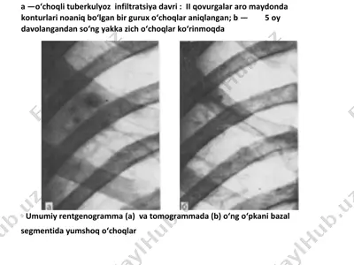 o'choqli tuberkulyoz infiltratsiya davri — PDF