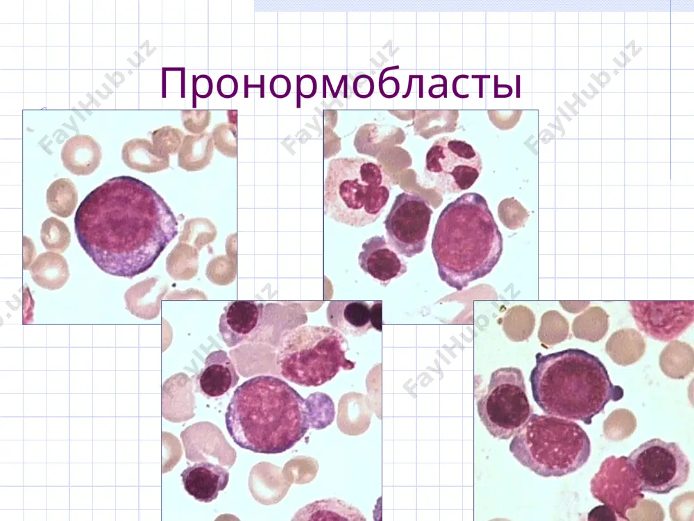 - при циррозе печени, у пациентов, находящихся на аик, космонавтов после приземления. микроангиопатической гемолитической анемии;жда; двс-синдроме; заболеваниях печени; после спленэктомии и при гипоспленизме; дефиците витамина е; гипотиреозе; синдроме мальабсорбции. акантоцит эритроцитлар хар хил формага кириб қолади, худди акация баргларига ўхшаб. мембранасини ўзгаришининг асосий сабаби, холестерин миқдорини камайиши, тг , фллар эритроцитлар мембрана липид қаватига яқин келиб қолади, лецитин концентрацияси пасайиб кетади, фосфатидилхолин, сфингомиелин ошиб кетади,шу сабаб мембрана структурасига таъсир этади. абеталипопротеинемия ва бошқа гемолитик қамқонликда эритроцитлар мембрана липид қаватларининг бузилишида келиб чиқади. симптоматик акантоцитоз – жигар циррозида, аикси бор беморларда, космонафтларнинг ерга қўнган пайтида кузатилади. микроангиопатик гемолитик анемия;жда; двс-синдроми; жигар касалликлари; спленэктомиядан сўнг ва гипоспленизмда ; витамина е етишмовчилигида ;гипотиреоз; мальабсорбция синдромида. мишеневидный эритроцит(кодоцит) мишеневидные клетки (кодоциты, лептоциты, таргетные клетки, колоколоподобные клетки) – плоские бледные эритроциты с окрашенной периферией (наружным ободком) и окрашенным центром (центральным скоплением гемоглобина в виде мишени) и находящимся между ними кольцом просветления. если смотреть на клетку …