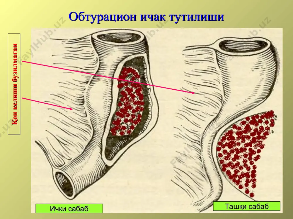 ўткир ичак тутилиши - Page 4