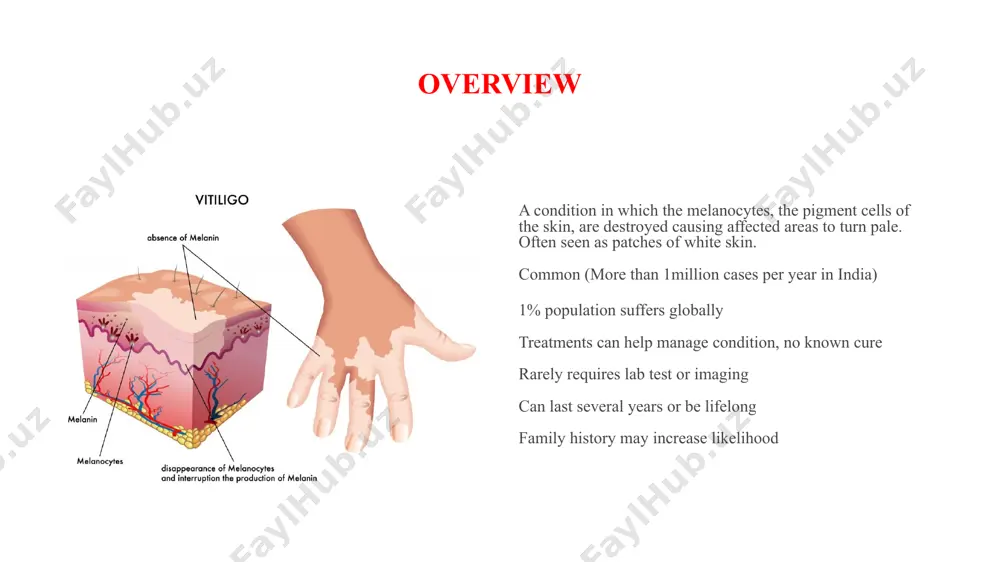 in the location of the patches of depigmentation. new patches also appear over time and can be generalized over large portions of the body or localized to a particular area. extreme cases of vitiligo, to the extent that little pigmented skin remains, are referred to as vitiligo universalis. nsv can come about at any age (unlike segmental vitiligo, which is far more prevalent in teenage years). classification of vitiligo classes of non-segmental vitiligo include the following: generalized vitiligo: the most common pattern, wide and randomly distributed areas of depigmentation universal vitiligo: depigmentation encompasses most of the body focal vitiligo: one or a few scattered macules in one area, most common in children acrofacial vitiligo: fingers and periorificial areas mucosal vitiligo: depigmentation of only the mucous membranes segmental segmental vitiligo (sv) differs in appearance, cause, and frequency of associated illnesses. its treatment is different from that of nsv. it tends to …