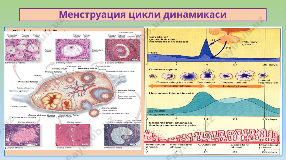 зоплазия дейилади. без бўлаклари ва чиқарув найчалари эпителийси гиперпла-зияланган, зич склероз билан ўралган. ҳомиладорлик ва туғишдан кейинги давр касалликлари ҳомиладорликка боғлиқ касалликлар: 1) токсикоз (преэклампсия), 2) бачадондан ташқари ҳомиладорлик, 3) ўз-ўзидан аборт, 4) бола ташлаш, 5) чала туғилиш. туғиш ва абортдан кейинги касалликлар: 1) плацентар полип, 2) елбўғоз, 3)синцитиал эндометрит, 4) трофобласт касаллик, 5) хорионкарцинома. преэклампсия, бу – ҳомила метаболитлари ва токсинлари таъсирида она организмининг захарланиш касаллигидир. патогенези: буйрак дисфукцияси, гормонал, иммунологик, нейроген бузилишлар, коагулопатия. патологик анатомияси – бош мия, ўпка, юрак, жигар, буйрак майда томирларида тарқоқ тромбозлар, тўқимасига қон қуйилишлар, паренхимасида некрозлар аниқланади. асоратлари: двс синдром, help-синдром, бош мия, ўпка ва жигарга массив қон қуйилишлар. ўлим сабаблари: жигар ва буйрак етишмасликлари, двс-синдром, ҳаётий муҳим аъзоларга қон қуйилишлар. бачадон найи ҳомиладорлиги бачадондан ташқаридаги ҳомиладорлик: бачадон найи, тухумдон ва қорин бўшлиғида бўлиши мумкин. бачадон найи ҳомиладорлиги – суринкали яллиғланиш, туғма аномалия, ўсмаларда, тухум ҳужайра харакатланишдан тўхтаб, шу жойда ҳомиладорлик ривожланади. макро …