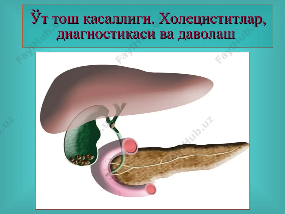 lligining kechish bosqichlari 1. fizik va ximik jarayon (litogen o't suyuqligi) bosqichi - klinik manzara yo'q. 2. latent (belgisiz) kechim - o't pufagidagi tosh bezovta qilmaydi, ular boshqa sabablarga ko'ra tekshiruvlarda topiladi. 3. yaqqol namoyon bo'lgan klinik manzara. o'tkir xoletsistit, xoledoxolitiaz, fater so'rg'ichi stenozi, mexanik sariqlik, o'tkir xolangit, o'tkir pankreatit va boshqalar rivojlanishi. o'tkning sub'ektiv belgilari: o'ng qovurg'a ravog'i ostidagi og'riq, ko'ngil aynishi, og'izda achchiq ta'm sezgisi, jig'ildon kaynashi, zarda bo'lish, qayt qilish (qusish), og'riqlarni ovqatlanishga bog'liqligi, qorinning dam bo'lishi, o'tkda og'riq lokalizatsiyasi o'ng qovurg'a ravog'i ostida, epigastral sohada o'tk diagnostika usullari duodenal zondlash ultratovushli tekshiruv (uzi) kontrast rentgenografiya (xoletsisto-, xolangiografiya) kompyuter tomografiya (kt) laparoskopiya magnit-rezonans tomografiya (mrt). o't pufagining normal manzarasi (uzi) 1. o't qopi bo'shlig'i 2. o't qopi devori 3. o't qopi yo'li 4. jigar to'qimasi o't pufagidagi toshlar (uzi) xoletsistografiya 1. o't qopi soyasi 2. umumiy o't yo'li soyasi 3. umurtqa pog'onasi 4. kovurg'alar xoletsistografiya (o't qopida …