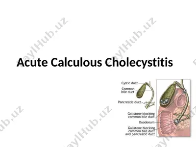 acute calculous cholecystitis — PPTX