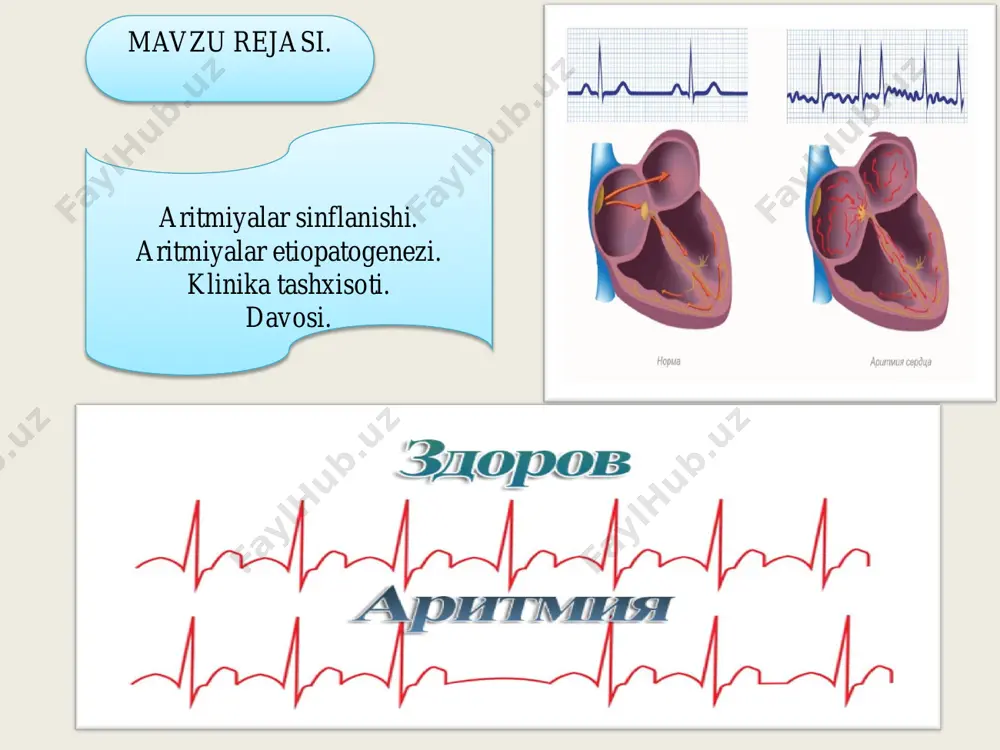 ingi interval r-r davomiyligi,pauzadan oldingi interval p-p ga nisbatan cho‘zilgan. 3) pauza oldingi 2 ta p-p intervalidan kichikroq bo‘lishi kerak. 2-dr. 2 tip ekg belgisi: 1) p-p interval pqrst tushib qolishdan oldin ham keyin ham bir hil bo‘ladi. 2) pauza davomiyligi 2 ta yoki undan ko‘proq p-p intervalga teng bo‘ladi. bo‘lmacha ichi qamali-bo‘lmachalar traktidan impuls o‘tishi buzilishiga aytiladi. ekg belgilari: 1) p tishcha davomiyligi 0,11-0,18 sek. ortiq bo‘ladi. 2) p tishcha kengaygan 2 teng o‘rkachli bo‘ladi. p tishcha amplitudasi o‘zgarmaydi atrioventrikulyar qamalda bo‘lmachadan qorinchaga impuls o‘tishini buziladi. 3 ta darajasi bo‘ladi.mobits 1,2,3. 1-dr va 2 dr noto‘liq;3 dr to‘liq qamal bo‘ladi. bu qamallarni p-q intervalni oraliq kengligiga qarab aniqlanadi.normada kattalarda p-q -0.12-0.20 sek.gacha,bolalarda p-q -0.11-0.18 sek.gacha bo‘ladi. av qamalni 1-darajasida butun sinus tugunidan chiqqan impulslar bo‘lmachalar qo‘zg‘alishiga olib keladi va barchasi av tugundan o‘tib qorinchalarga etib keladi lekin av tugunda ko‘proq va uzoqroq ushlanib qoladi.ekgda p-q oraliq bir xil va …