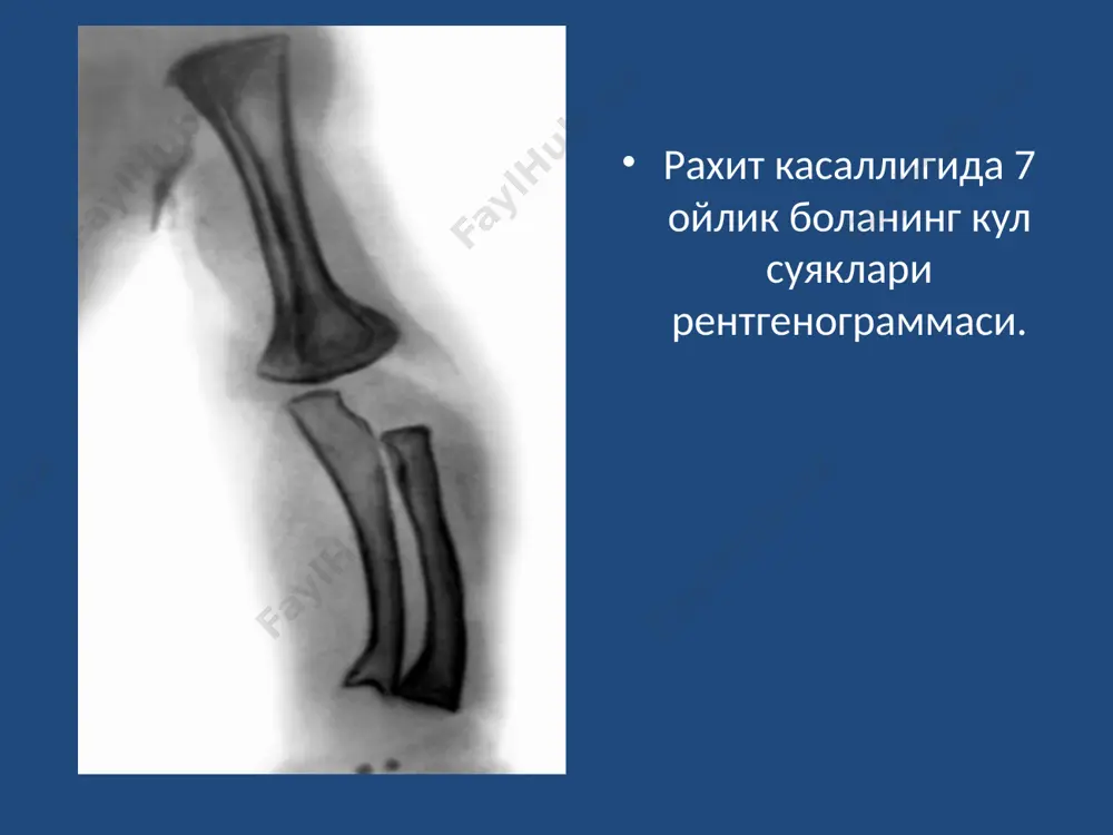 д а в о л а ш рахитни даволашда болани рационал овқатлантириш муҳим ахамиятга эга (овқат рационида витаминларга, минерал моддаларга, айниқса кальцийга бой) бўлиши, тоза ҳавода етарли даражада бўлиши, массаж ва гимнастика даволашнинг асосий омилларидан ҳисобланади. рахитда цитратларни ҳам тавсия қилинади. витамин д билан даволаш муддатида гипервитаминоз днинг олдини олиш ва витамин д га сезгирликни аниқлаш мақсадида сулькович синамаси ўтказилиб турилиши лозим. витамин днинг спиртли эритмалари билан даволаш мобайнида витаминлар а, в1, в2, в5, в6, атф билан бирга тавсия қилинади. рахитнинг репарация ва қолдиқ асоратлари даврида тузли, хвояли, тузли-хвояли, ультра бинафша нурлар, қумли ванналар, суяк ва мушаклар диатермияси, массаж, гимнастика, қуёш ва денгиз ванналари ижобий таъсир қилади. кальций ва фосфор факат чуқур чала туғилган чақалоқларда тавсия қилинади (м: кальций глицерофосфат 0,05 дан 3 марта овқатдан олдин берилади). п р о ф и л а к т и к а рахит профилактикаси специфик ва носпецифик бўлади. рахитни бола ҳали туғилмасдан антенатал …