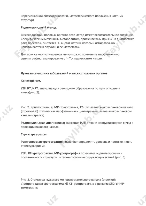 оловых органов этот метод имеет вспомогательное значение. специфическим меченным метаболитом, применяемым при пэт в диагностике рака простаты, считается 11с-ацетат натрия, который избирательно накапливается в опухоли и ее метастазах. для поиска неопустившегося яичка можно применить перфузионную сцинтиграфию: сканирование с 99m тс- пертехнатом натрия. лучевая семиотика заболеваний мужских половых органов. крипторхизм. узи,кт,мрт: визуализация овоидного образования по пути опущения яичка(рис. 2). рис. 2. крипторхизм: а) мр- томограмма, т2- ви: левое яичко в паховом канале (стрелка); б) статическая перфузионная сцинтиграмма: левое яичко в паховом канале (стрелка) радионуклидная диагностика: фиксация рфп в ткани неопустившегося яичка в проекции пахового канала. стриктура уретры. рентгеновская уретрография позволяет определить уровень и протяженность стриктуры(рис 3). узи, кт-уретрография, мр-уретрография позволяет оценить уровень и протяженность стриктуры, а также состояние окружающих тканей (рис. 3) рис. 3. стриктура мужского мочеиспускательного канала (стрелки): а)ретроградная уретрограмма, б) кт- уретрограмма в режиме ssd; в) мр- томограмма рецидивирующее варикоцеле. рентгеновская ангиография (венография): визуализируется место сброса крови в яичковую …