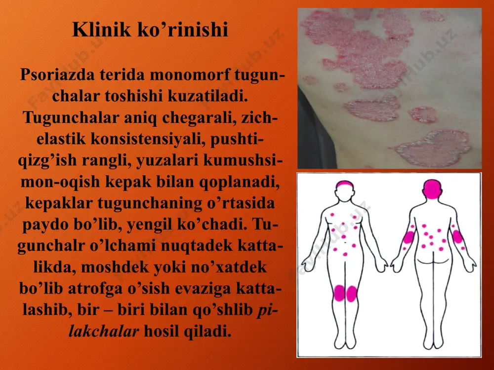 vbatda oshqozon-ichak aksalliklari, jigar, oshqozon osti bezi holati ahamiyatga ega. 2. ayrim hollarda kasallik bevosita tomir (xafaqon) va endokrin(qandli diabet) patologiyalari bilan bog’liq. 3.malum darajada og’iz shilliq qavatining tish patologiyasi tufayli travmizatsiyaga uchrashi sabab bo’ladi. turli xil metallardan tayyorlangan qoplama tishlar so’lak tarkibiga kirib jiddiy tasir etadi, so’lak tarkibida metall zarrachalari kuzatilib, galvanik element toklar hosil bo’ladi. bu holat sabab fermentlar ajralishi sekinlashadi. bu ham kasallik kelib chiqishida malum ahamiyatga ega klinikasi kasallikning asosiy morfologik elementi papulalar bo’lib, uning quyidagi o’ziga xos xususiyatlari bor: 1. poligonal , yassi shaklli 2. papulalar yuzasida (asosan markazida) kindiksimon botiq bo’lishi 3.periferiyaga qarab o’sadi 4. toshmalar ustiga o’simlik moyi surtilsa, to’rsimon shakllar vujudga keladi- uikxem setkasi 5. o’tuvchan yorug’likda toshmalar yuzasining pushti-binafsha rangda yaltirab turishi 6. lunj ichki shilliq qavatida oqish papulalarning paydo bolishi – pospelov – neyman simptomi. uikxem setkasi toshmalarning asosiy joylashadigan sohalari qo’l va oyoq panjalarining yuza qismi, bilakning ichki yuzasi, …