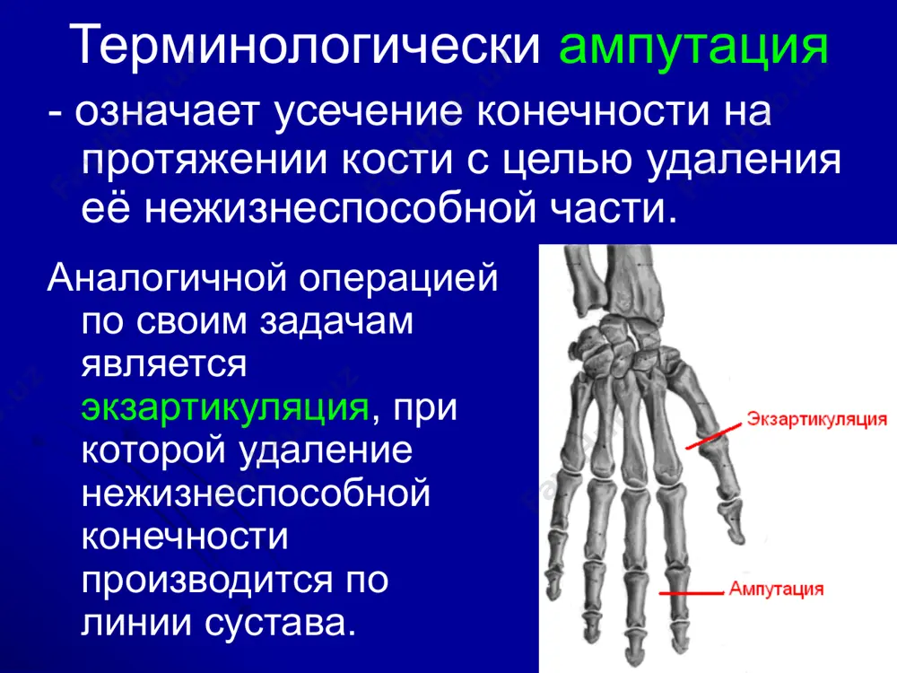 e tissue; deformities of limbs уровень ампутации (место перепила кости, которое определяет длину культи и её функциональные возможности). 2 основных направления: как можно дистальнее. в военное время – это предварительная операция: отсроченный шов, реампутация; реконструкция; протезирование, индивидуальный протез. в мирное время ампутация с соблюдением всех правил техники. ампутация в пределах выбранных «оптимальных» зон. военное время – идея стандартизации не только протезов, но и уровня ампутации. amputation should be distally. it should be in the selected "best" areas. культи «ценные». в мирное время - индивидуальное протезирование. государственная, социальная защита. in peacetime - individual prosthetics. state, social protection. схема уровней ампутаций. levels of amputation техника ампутаций включает 3 этапа: techniques of amputations include 3 stages: рассечение мягких тканей; обработка надкостницы и перепил кости; «туалет культи»: перевязка сосудов и усечение нервов - «фантомные боли». dissection of the soft tissues; processing drunken periosteum and bone; "toilet cult": ligation of vessels and nerves truncation - …