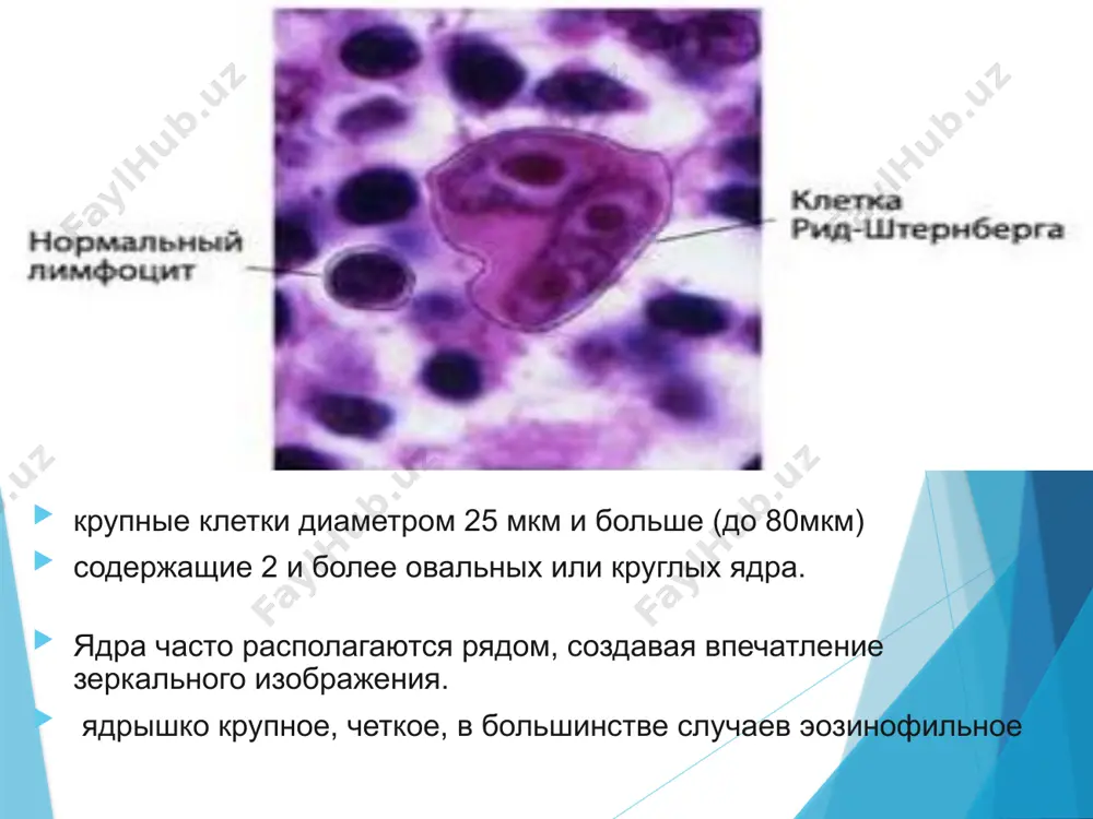 рой разрастание опухолевой ткани обнаруживают не только в лимфатических узлах, но и в селезенке, печени, легких, желудке, коже. выделяют следующие локализации лгм: периферическая форма (поражение поверхностных лимфатических узлов) медиастинальная абдоминальная легочно-плевральная желудочно-кишечная костная кожная нервная формы лгм по скорости течения процесса: острая - болезнь проходит от начальной стадии до конечной за несколько месяцев. хроническая – заболевание растягивается на много лет с циклическими обострениями и ремиссиями. i стадия поражение одной лимфатической зоны или структуры или поражение одного экстралимфатического органа или ткани (ie) в пределах одного сегмента. к лимфатическим структурам относятся лимфатические узлы, селезенка, вилочковая железа, кольцо вальдейера, червеобразный отросток и пейеровы бляшки. ii стадия поражение двух и более лимфатических зон по одну сторону диафрагмы или локализованное поражение одного экстралимфатического органа или ткани и их регионарных лимфатических узлов с или без поражения других лимфатических областей по ту же сторону диафрагмы (iie) iii стадия поражение лимфатических узлов и структур по обе стороны диафрагмы, …