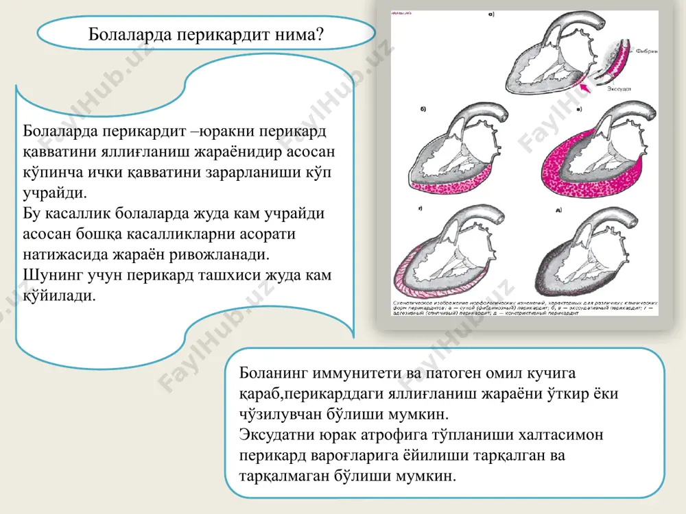 вматик касаллик; кўкрак қафасини трвматик жарохати; кучли таъсир этувчи дори моддаларни узоқ вақт ичиш, буйракни яхши ишламаслиги ёмон сифатли ўсмалар метоболик касалликлар-падагра,тириотоксикоз, болаларда перикард патогенези. кўп холларда перикард яллиғланишини келиб чиқишида болаларни иммун тизимини нотўғри ишлаши сабаб бўлади. йирингли патологик жараёнлар пайти перикард учун метостатик деб хисобланади,бу юракнинг сероз мембранасига қоннинг қуйилиши ёки йирингли таркибнинг юракнинг мушак мембранасидан перикаридиал қопчага кириб бориши билан боғлиқ. перикарддаги уремик яллиғланиш жараёни буйракларнинг етарли даражада ишламаслиги билан ривожланади ва танани айланма моддалар билан захарлаш натижасида юзага келади. болаларда перикарднинг белгилари. касаллик ҳеч қандай перикардитга хос аниқ белгиларсиз ўткир бошланади. агар суюқлик тўпланса ёки фибринли қоплама бўлаётган бўлса,текширув вақтида перикардда шовқин тарқалиши,оғриқ,ҳамда юракни катталашиши кузатилади. юрак бўшашаётган вақтда юракни қон билан тўлишини камайиши шундан дарак берадики бунда юрак камералари эзилиб экссудат тўпланаётганлигида бўлади. бу холат ковак вена тизимида қонни тўпланиши натижасида қора талоқ ва жигарни катталашиши ва тўқималарни шишишига олиб келади. перикардитни яққол белгиси бу …