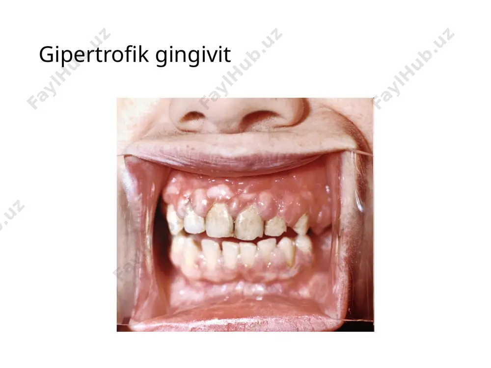 paradont kasalliklari nur tashxisi - Page 4