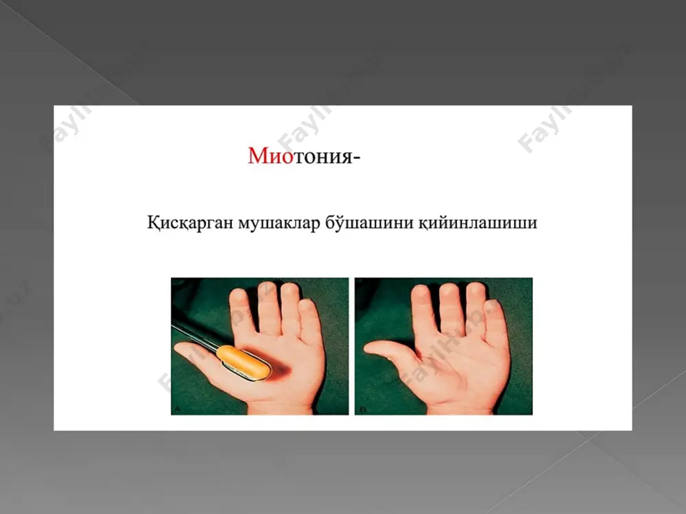 stki distal periferik paraparez-ham harakat, ham sezgi buzilishlari kuzatiladi. psevdogipertrofiyadan tashqari barcha yuqoridagi miopatiyalar simptomakompleksi kuzatiladi. test a dyushenn miopatiya b sharko mari s erba – rott d bekker psevdogipertrofiyadan tashqari barcha yuqoridagi miopatiyalar simptomakompleksi kuzatiladi. s erba – rott 15-25 yoshlarda rivojlanadi test a dyushenn miopatiya b landuzi-dejerin s erba – rott d bekker b landuzi-dejerin 15-25 yoshlarda rivojlanadi tomson miotoniyasi autosom –dominant turda nasllanadi. mushak tonusining patologik balandligi bukilgan mushaklarni yozish qiyinligi kuzatiladi krampilar, yuzida blefarospazm kuzatiladi bola tana tuzilishi –”atletik”- tana mushaklari yaxshi rivojlangan jismonan baquvvatga o'xshash bo'ladi juda sekin avj oladi, hayot uchun havfsiz kurshmann – batten-shteynert miotoniyasi - distrofik miotoniya bo'lib, barcha simptomlar tomson miotoniyasi kabi + mushak atrofiyasi oppengeym miatoniyasi autosom retsessiv va autosom dominant tur tug'ma mushak tonusining o'ta pastligi, bo'shligi, lattadek cho'zilishi xos ko'pincha bola jismoniy rivojlanish etaplaridan orqada qolib o'sadi bo'g'imlar rekurvatsiyasi, pay reflekslari juda sustligi, atrofiyalar esa xos emas hayot …