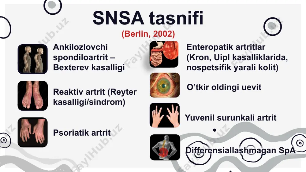 ega. yonbosh mushaklari atrofiyasi, ularning zoʻriqishi kuzatiladi. kasallikning erta va muhim belgilaridan biri beldagi ogʻriq va karaxtlik hisoblanadi. ogʻriq ertalab kuchayadi, jismoniy mashq va issiq muolajalardan soʻng kamayadi. toʻsh-qovurgʻa birikmalari ankilozlari paydo boʻlishi hisobiga koʻkrak qafasi ekskursiyasi keskin kamayadi. tos-son va yelka boʻgʻimlarining shikastlanishi ushbu boʻgʻimlarning shikastlanishi simmetrik xarakterga ega, asta-sekin boshlanadi, koʻpincha ankilozirlanish bilan tugaydi. boʻyin qismi harakatlarning keskin cheklanishi bemor engagi toʻsh suyagiga yetmaydi. entezopatiya tovon suyagining tovon payi va panja orqasi aponevroziga birikkan joyi yallig’lanishi hisoblanadi. tayanch-xarakat tizimi zararlanishi tilanchi holati umurtqa pogʻonasi koʻkrak qismi yaqqol ifodalangan kifozi va boʻyin qismi giperlordozi kuzatiladi. tananing frontal yuza boʻylab egilishida bukilgan tomonda orqa toʻgʻri mushaklari boʻshashining boʻlmasligi - «kamalak ipi» simptomi kuzatiladi. yurak qon-tomir tizimi zararlanishi bemorlar hansirash, yurak o’nab ketishi, yurak sohasidagi og’riqlarga shikoyat qiladilar. bu shikoyatlarning sababi aortit, miokardit, perikardit va miokardiodistrofiya hisoblanadi. ularda ritm buzilishlari, aortada sistolik shovqin, yurak tonlari boʻgʻiqligi kuzatilishi mumkin. baʼzan rivojlanib boruvchi …