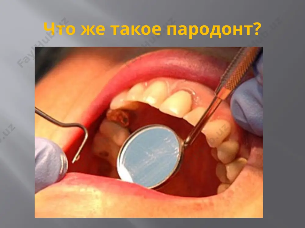 ки качества чистки зубов используют индексы гигиены. следующим этапом в оценке местного статуса является определение степени подвижности зубов. принято условно различать четыре степени подвижности зубов: i степень — подвижность зуба в вестибулооральном направлении меньше 1 мм; ii степень — смещение в вестибулооральном и медиодистальном направлении на величину до 1 мм; iii степень — смещение зуба в вестибулооральном и медиодистальном направлении на величину более 1 мм; iv степень — полная деструкция костной ткани и смещение зуба во всех направлениях. глубину пародонтального кармана измеряют с помощью специального зонда с градуированной шкалой. измерения следует проводить с четырех сторон зуба во всех стадиях патологического процесса в пародонте. особое значение этот метод приобретает при исследовании после хирургического лечения. компьютерная диагностика пародонта системой «florida probe» программно-аппаратный комплекс «florida probe» даёт возможность врачу абсолютно безболезненно, быстро и очень точно проводить обследование тканей пародонта (десен), и автоматически заносить результаты в компьютерную базу данных. всего за 20-30 мин с …
