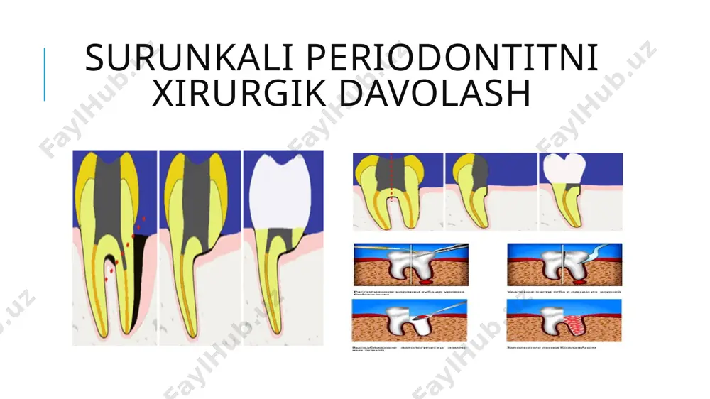 surunkali periodontitlarni konservativ-xirurgik davolash usullari - Page 4
