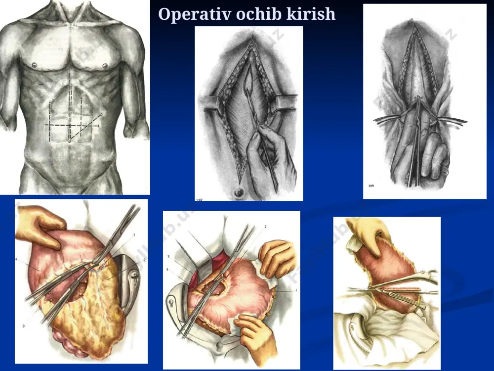 ativ aralashuvlar fassiya – bu ingichka, yarimshaffof biriktiruvchi to‘qimali qobiq, unda biriktiruvchi to‘qimali tolalar yo‘nalishida muqim tartib deyarli yo‘q. fassiyalar kletchatka bo‘shliqlarini chegaralaydi, muskullar uchun fassial g‘ilof, qon tomir-nerv tutamlarga fassial qin hosil qiladi. fassiyaning ushbu xususiyatlari yiringli-yallig‘lanish jarayonlarining rivojlanishi va tarqalishida amaliy ahamiyatga ega aponevrozlar – anchagina zich va qalin biriktiruvchi to‘qimali varaqlar bo‘lib, anatomik tuzilmalarni bir-biridan chegaralaydi, ba’zi joylarda paylarning davomi hisoblanadi. aponevrozlarda biriktiruvchi to‘qimali tolalar qat’iy yo‘nalishlariga ega va 3-4 qavat bo‘lib joylashgan. g‘ovak kletchatkada biriktiruvchi to‘qimali tolalarda umuman qandaydir bir yo‘nalish kuzatilmaydi, va kletchatkalar orasida keskin chegara yo‘q absses- yiringning chegaralangan holda to‘planishi. abssessni ochish eng yuqori flyuktuatsiya sathiga qarab bajariladi. ancha og‘ir masalalardan biri – bu chuqur flegmonalarni ochish uchun operativ ochib kirish usullaridir. flegmona – bu kletchatkaning o‘tkir yiringli tarqoq yallig‘lanishi. absseslardan farqli ularoq, flegmonalar aniq bir chegaraga ega emas. flegmona sababli kesishni amalga oshirishdan oldin shu sohadagi tomir-nerv tutami proyeksion chizig‘i aniqlaydi. yumshoq …