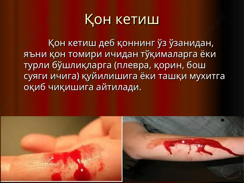 инг веноз қон кетишдан фарқлари белгилар артериал веноз ранг алвон тўқ қизил оқими пульсацияловчи пульсациясиз ахволи тез оғирлашади секин оғирлашади ўткир анемия тез ривож. секин ривож. хаво эмболияси бўлмайди бўлиши мумкин айланаётган қон миқдори (оцк)дан 15% йўқотилса кескин гемодинамик ўзгаришлар йўқ қон айланиш тизимида - “марказлашиш" қон томирлар спазми: тери рангининг оқариши қорин бўшлиғи аъзоларини микро- циркуляциясининг бузилиши 2. артериовеноз шунтларни очилиши қон томирлар қон кетишгача қон кетишдан кейин айланаётган қон миқдорининг 15% кўпроғи кетса организмнинг компенсатор хусусиятлари ақб тушиши қон томирлар спазми артерио-веноз шунтлар очилиши юрак уришининг тезлашиши - тахикардия тўқималар аро суюқликларва лимфанинг қон томир ичига ўтиши кортикостероидлар: альдостерон, антидиуретик гормоннинг ажралишининг ошиши суюқликни организмда ушланиб қолиши ақб ошиши қон кетишда юзага келадиган асосий бузилишлар: айланаётган қон миқдорининг камайиши ҳисобига ги-поволиемик шок ҳолати. буйрак паренхимасида гипоксия ва гипофильтрация ҳисобига - буйрак етишмовчилиги ривожланади. жигарда қон айланишнинг бузилиши ва гипоксия ҳи-собига жигар етишмовчилиги ривожланади. миокард ва бош мия гипоксияси …